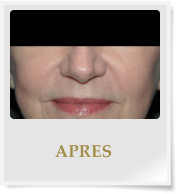 APRES