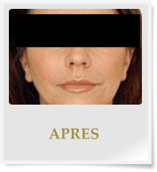 APRES