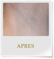 APRES