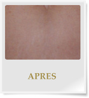 APRES